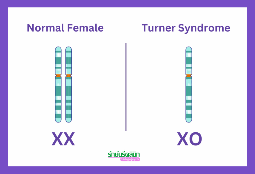 ความผิดปกติของโครโมโซมเพศ เทอร์เนอร์ ซินโดรม, XO (Turner Syndrome)