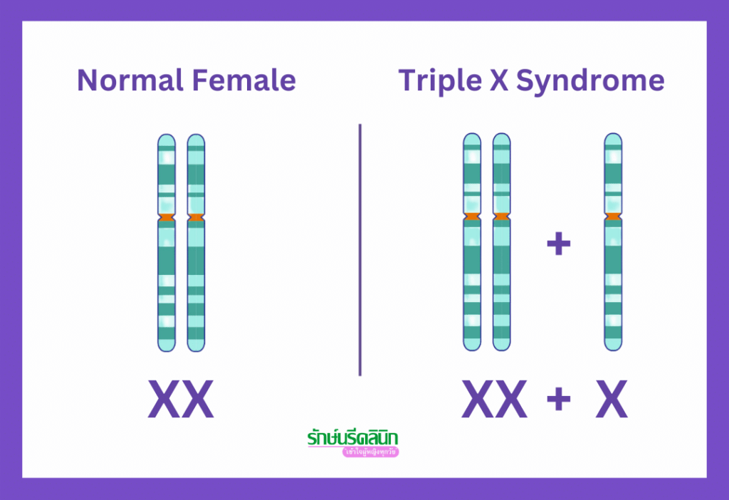 ความผิดปกติของโครโมโซมเพศ ทริปเปิ้ลเอ็กซ์ ซินโดรม, XXX (Triple X Syndrome)